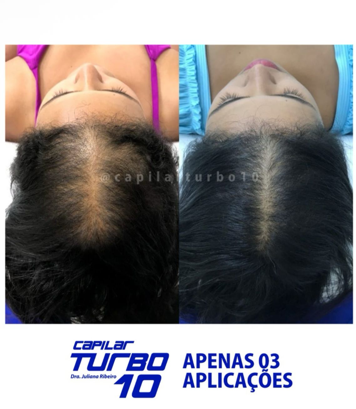 Antes e depois — Apenas 03 aplicações