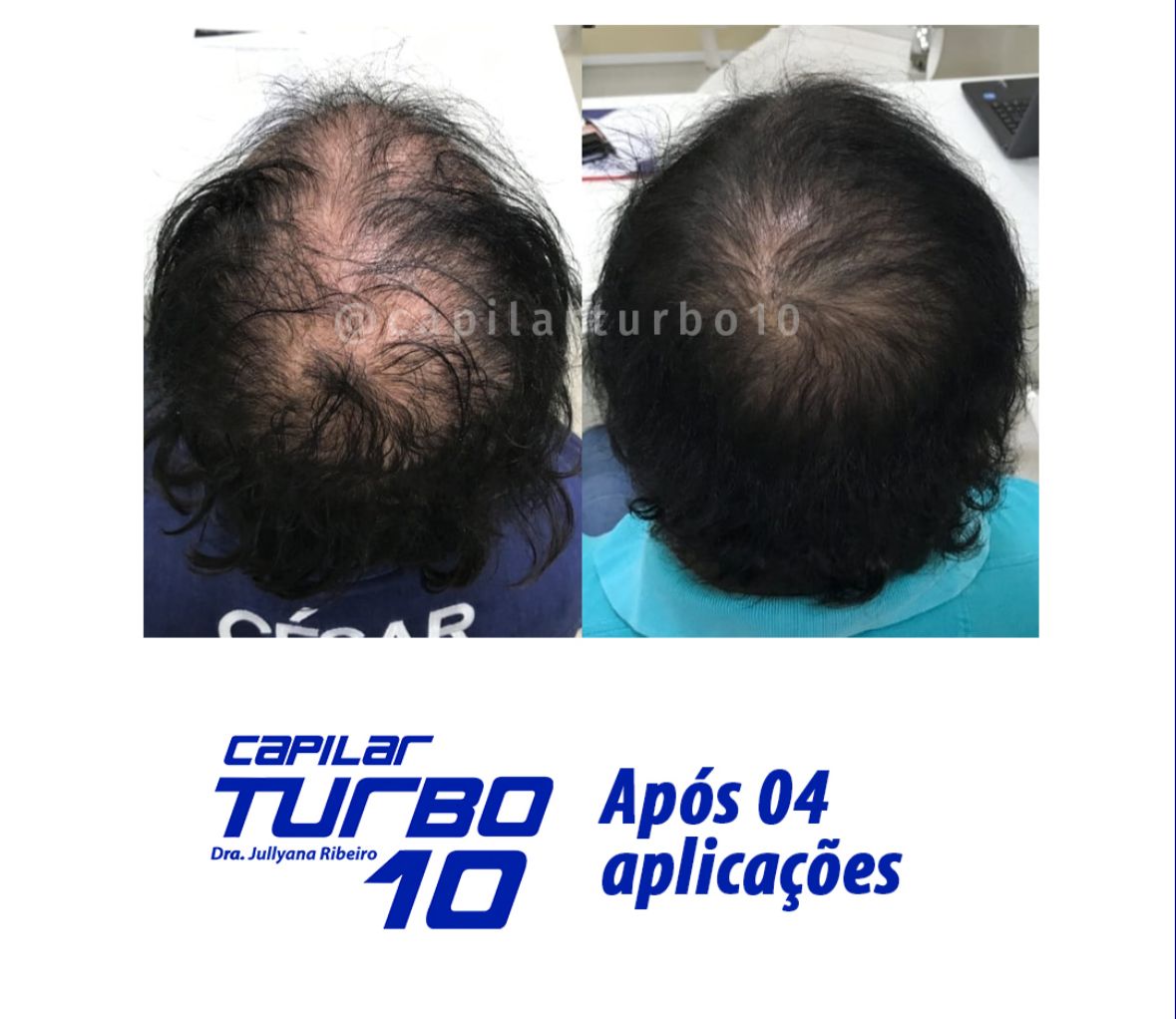 Antes e depois — Após 04 aplicações