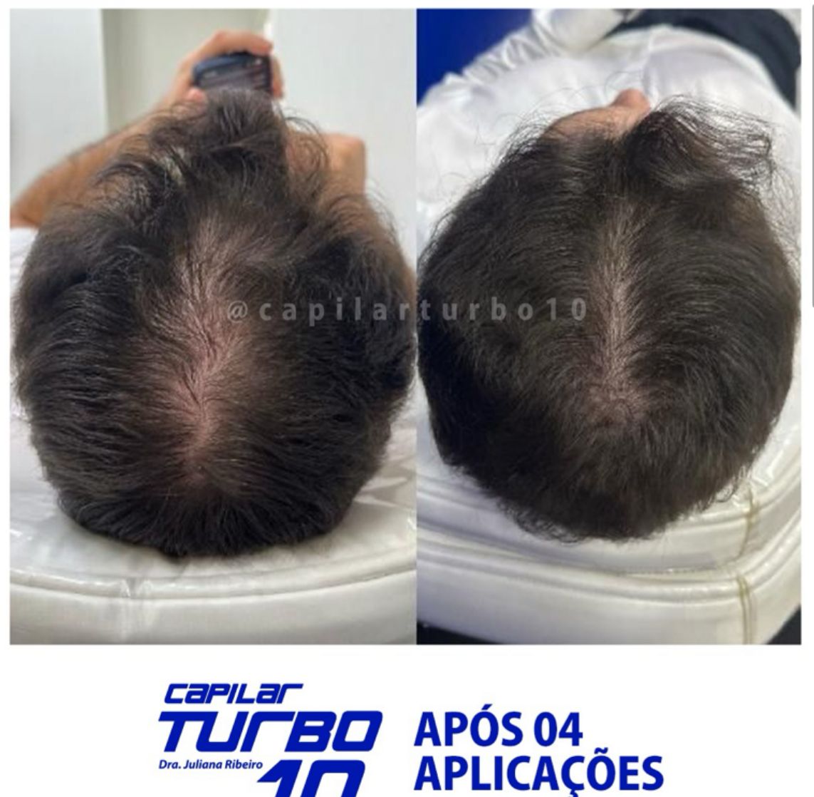 Antes e depois — Após 04 aplicações