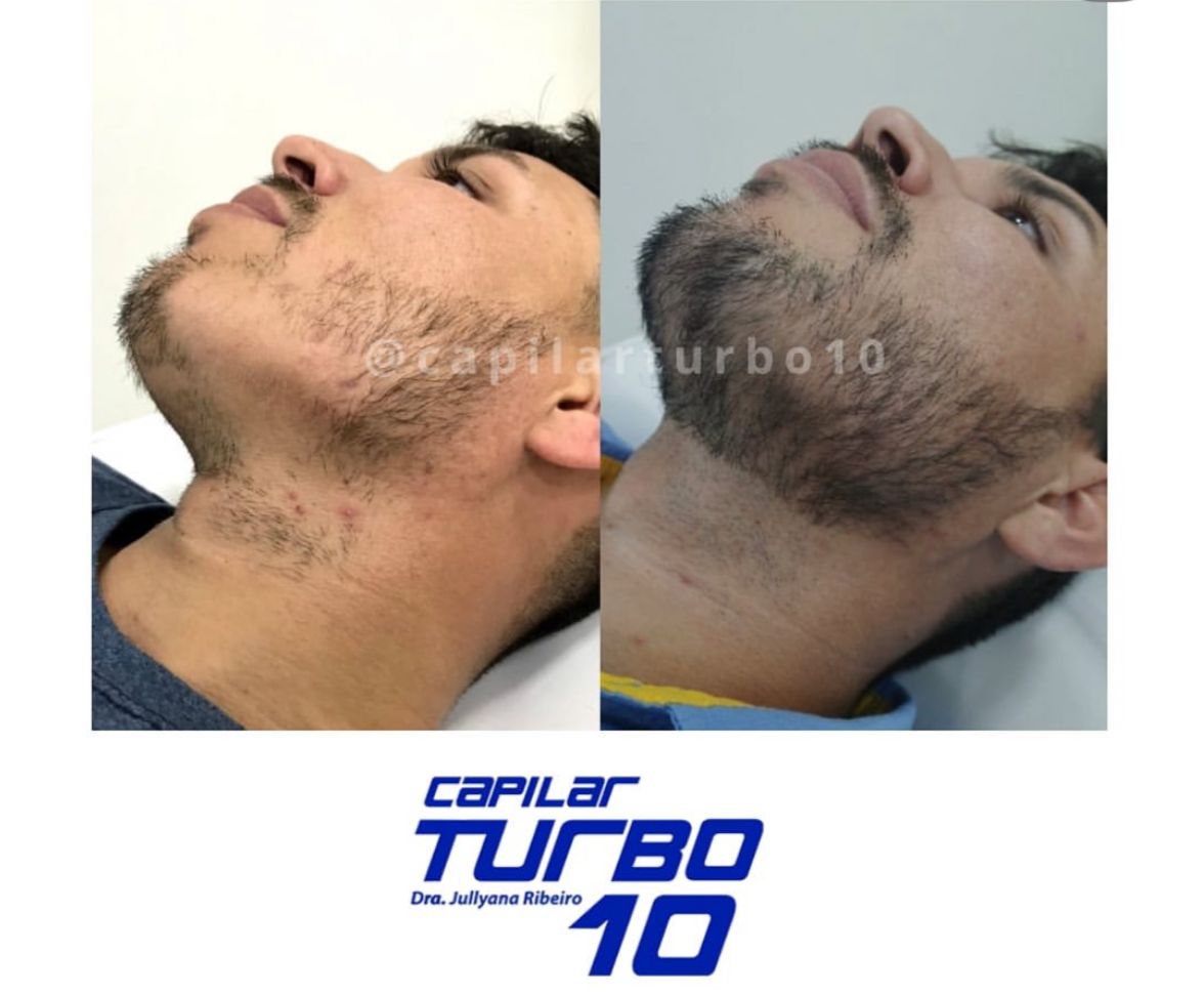 Antes e depois — Falhas na barba