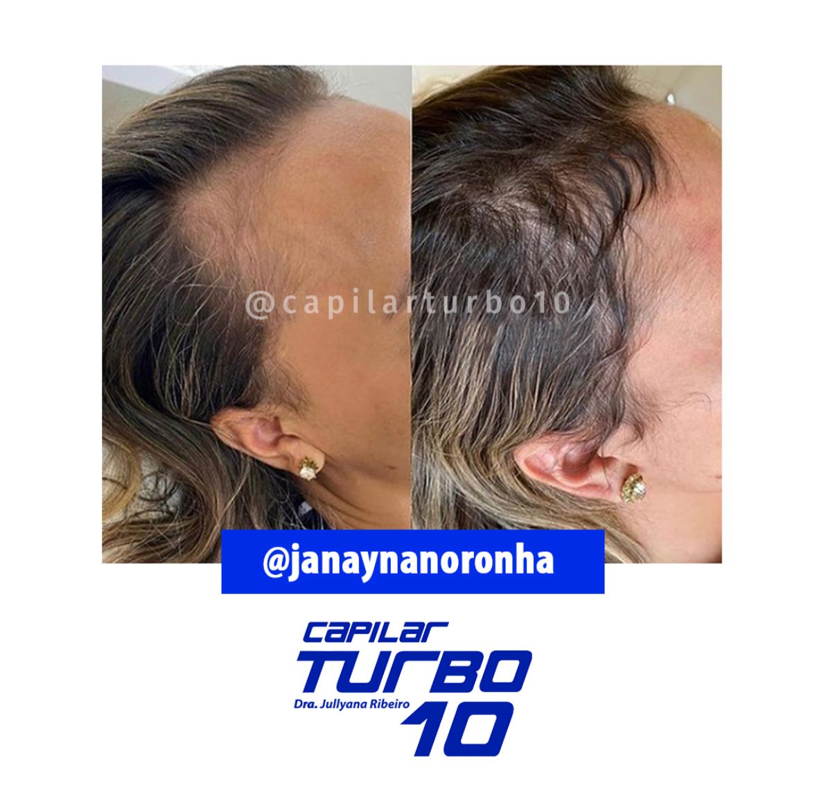 Antes e depois — Densidade capilar